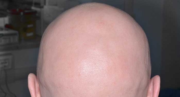 L'alopecia androgenetica: come si presenta