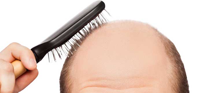 L'alopecia androgenetica: cause e sintomi