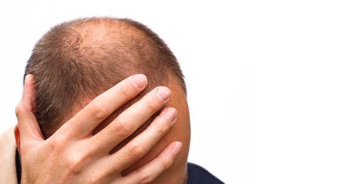 L'alopecia androgenetica: cause e sintomi