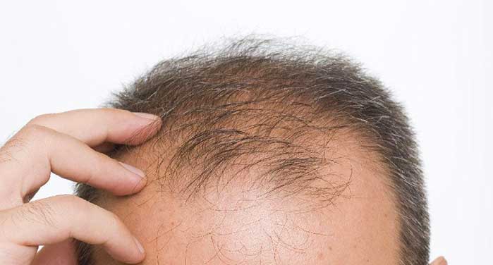 L'alopecia androgenetica: cause e sintomi