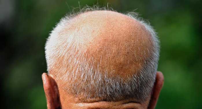 L'alopecia androgenetica: cause e sintomi