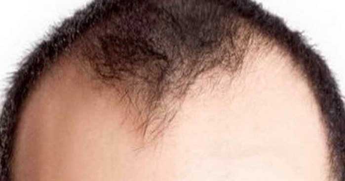 L'alopecia androgenetica: cause e sintomi