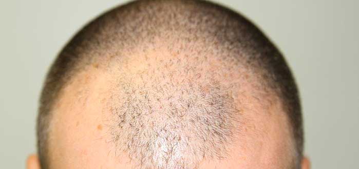 L'alopecia androgenetica: cause e sintomi