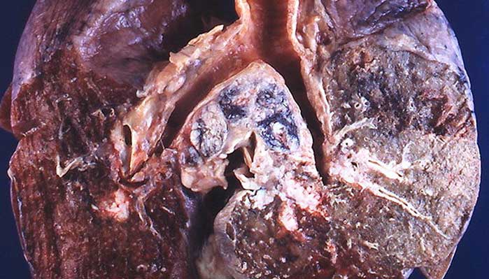 I danni del fumo: infiammazioni croniche e neoplasie
