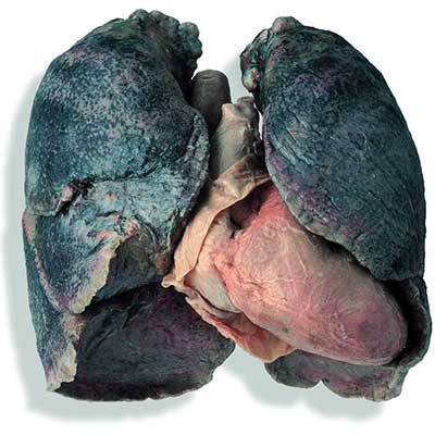 Lo stato dei polmoni di un fumatore di lunga data


