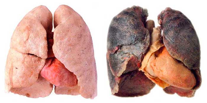 I polmoni sani di un non fumatore (a sinistra) contro i polmoni pesantemente danneggiati di un fumatore (a destra) 

